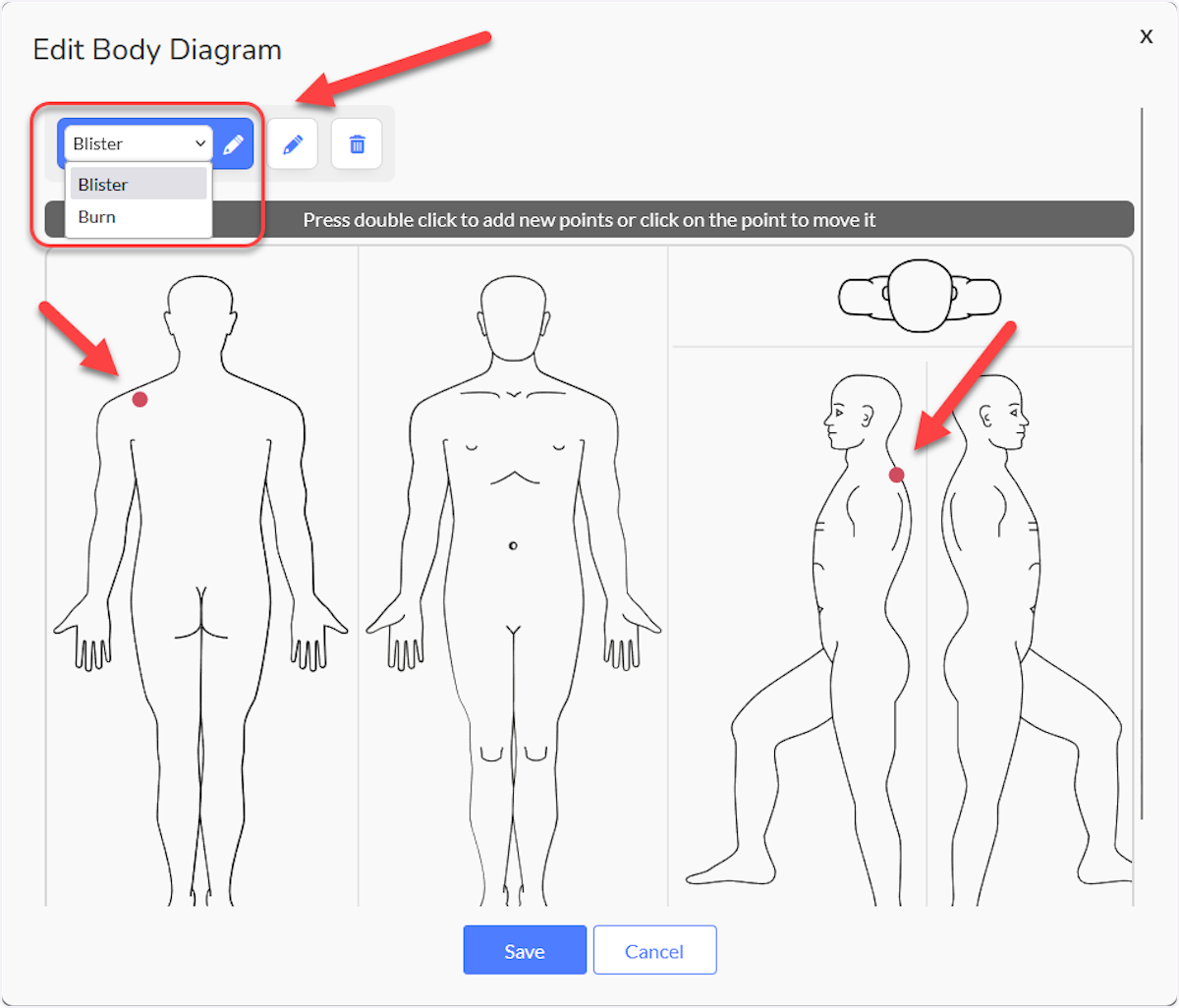 To note locations of Blister or Burns, select appropiatly and double click on the point.